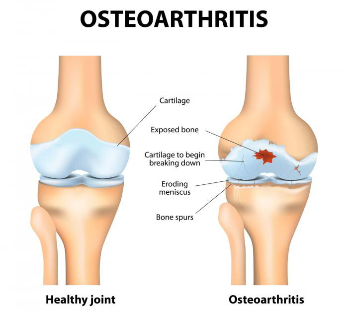 Image of Osteoarthritis Treatment with labeled parts