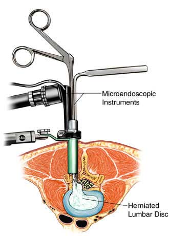 Instruments used for Spine Surgery