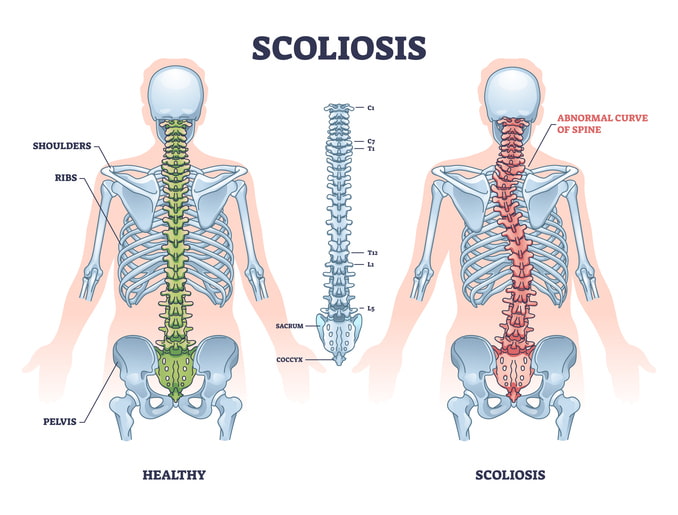 Scoliosis diagram comparing a healthy spine and an abnormal spinal curve in Dallas & Texas